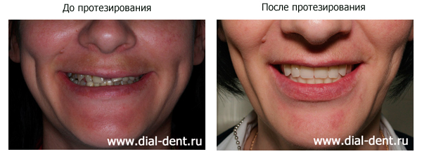 Имплантация зубов Москва Диал-Дент