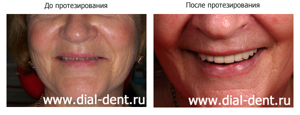 Имплантация зубов Москва Диал-Дент