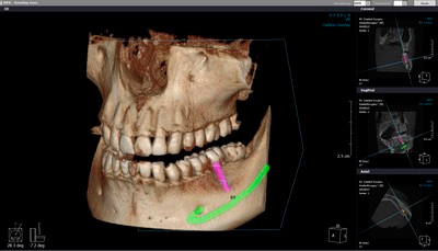 компьютерная томография зубов
