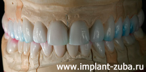 восковое моделирование при протезировании зубов