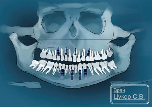 планирование установки зубных имплантов