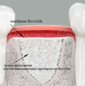 костная пластика при имплантации зубов