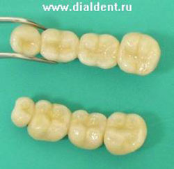 металлокерамические зубные протезы