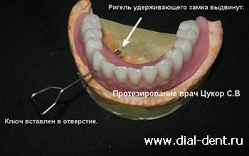 полностью съемный зубной протез на имплантах