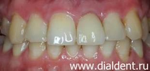 протезирование переднего зуба керамической коронкой на импланте
