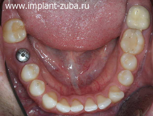 имплантация зубов, формирователь десны