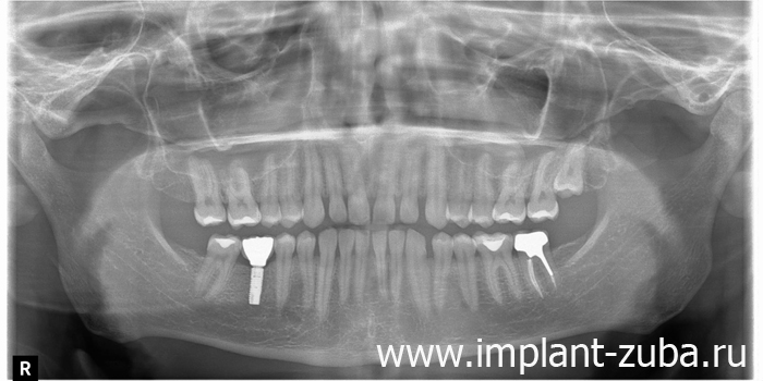 панорамный снимок после имплантации зубов