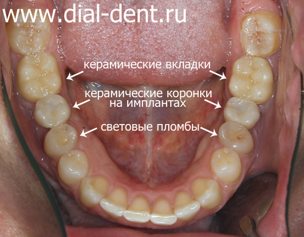 выполнено комплексное лечение, имплантация и протезирование зубов