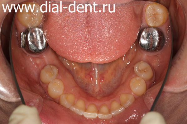 вид зубов до имплантации и протезирования