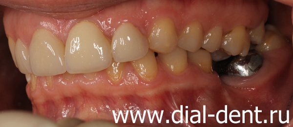 вид слева до лечения и протезирования зубов
