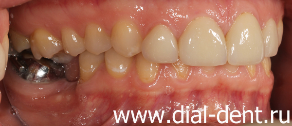 вид справа до лечения и протезирования зубов