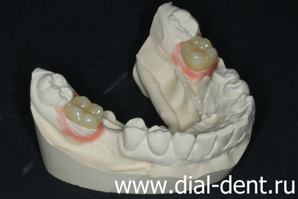 керамические вкладки в зубы на модели