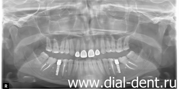 панорамный снимок зубов после лечения каналов и имплантации