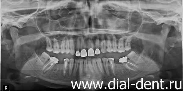 панорамный снимок зубов до лечения и имплантации